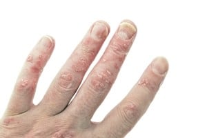 New drugs may better treat psoriasis.